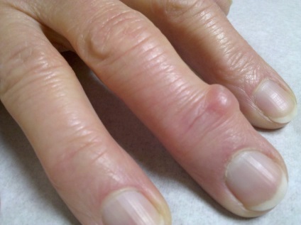 Hygroma pe degetul mare și articulațiile unui copil și a unui adult, modalități de tratament și îndepărtare