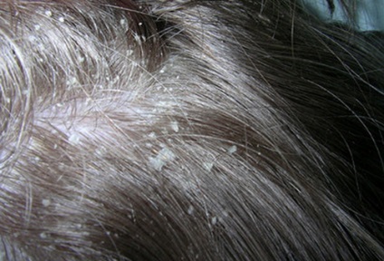 Hiperkeratoza cauzată de scalp, simptome, reguli de tratament, metode de tratament