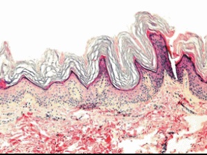 Hiperkeratoza pielii capului