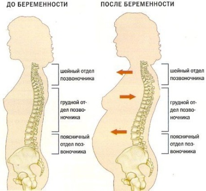 Hyperlordoza tratamentului lombar, coloanei vertebrale