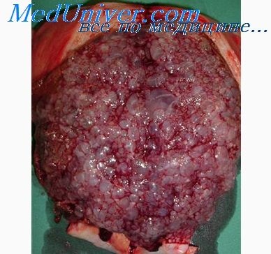 Hipertensiunea miometrului retroplacentric și a miomului uterin