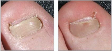 Ciuperca de ciuperci pe picioare - cum se trateaza unghiile