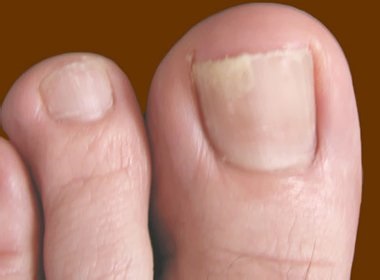 Гъбички ноктите симптоми, лечение, и причините на заболяването