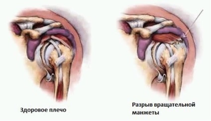 Impingerea sindromului articulației umărului este ceea ce este și cum trebuie tratată