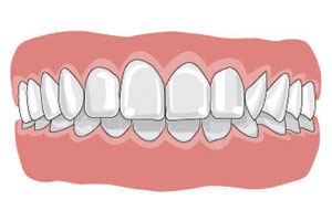 malocclusion