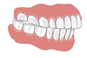 malocclusion