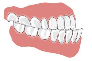 malocclusion