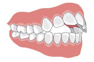 malocclusion