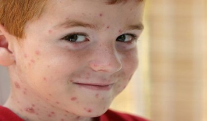 Cum se dezvoltă varicela la copii? Simptome și tratament?