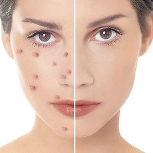 Cum să eliminați cicatricile (cicatricile) de la acnee pe metode de față