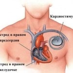 Heart pacemaker