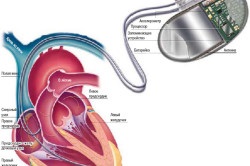 Dispozitiv cardiac pacemaker, implantare, viață după operație (video)
