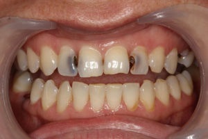Fogszuvasodás a fogak között - az elülső és az alsó metszők kezelése a fotók előtt és után