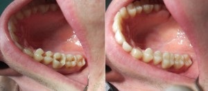 Cariile dintre dinți - tratarea incisivilor din față și inferior înainte și după fotografii