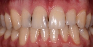 Fogszuvasodás a fogak között - az elülső és az alsó metszők kezelése a fotók előtt és után