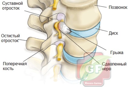 Karipazim cu o hernie a coloanei vertebrale, instrucțiuni de electroforeză privind aplicarea tratamentului pentru hernie