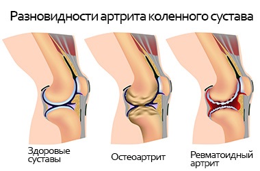 Chisturile articulației genunchiului, simptomele și tratamentul