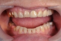 Coroane de mestecat pentru dinți