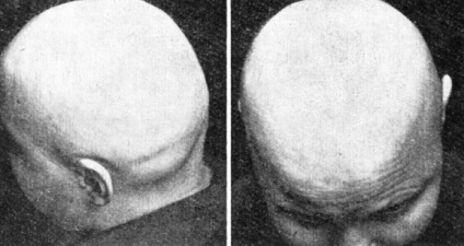 Alopecia circulară sau chelie de cuibărit 1960 zalkind e