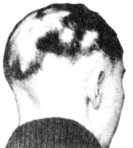 Alopecia circulară sau chelie de cuibărit 1960 zalkind e