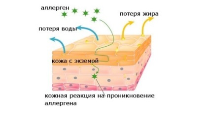 Tratamentul eczemelor cu remedii populare