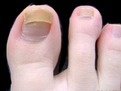 Лечение на гъбички на ноктите оцет за лечение на гъбички на ноктите оцет, съвети и трикове