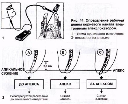 Metode de determinare a lungimii de lucru a canalului radicular - stadopedia