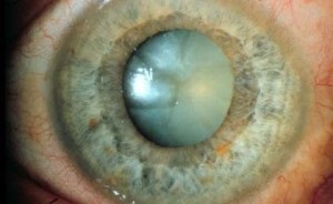 Simptome cataracte inițiale, tratament, medicamente