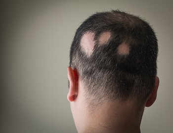 Alopecia focală - cauze și tratament al chelării cuiburilor