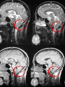 Operații sub anomalia arnold-chiari