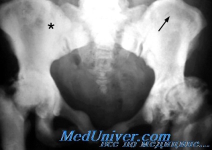 Osteopetrosis (márvány csontbetegség, Albers-Schonberg betegség) - klinikai kép, diagnózis, a kezelés