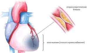 Boală cardiacă ischemică acută