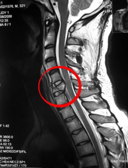 Fractura simptomelor, diagnosticului, tratamentului și reabilitării vertebrelor cervicale