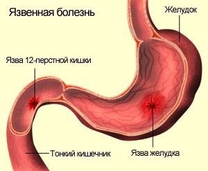 Nutriție pentru ulcer gastric și meniu duodenal pentru o săptămână, rețete, ce alimente pot fi