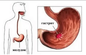 Berea cu gastrită stomacală - utilizare, beneficii și rău