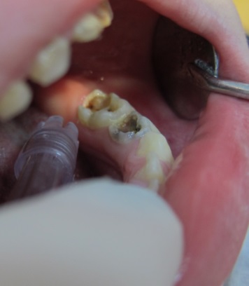 De ce vă doare dinte după instalarea sigiliului, tratamentul stomatologic