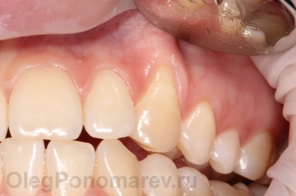 De ce dintii cervicali sunt descoperiti in legatura cu recesiunile gingiei, perfectsmile