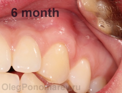 De ce dintii cervicali sunt descoperiti in legatura cu recesiunile gingiei, perfectsmile