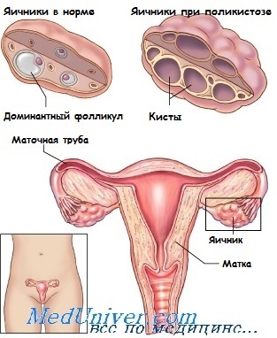 Ovarianul polichistic ca cauză a amenoreei - cauze, diagnostic