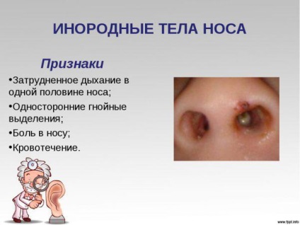 Polipi în nas în copil simptome și tratamentul de remedii populare, cum să se uite, cum să eliminați