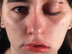 Efectele Botoxului Prevenirea edemelor și a pungilor sub ochi, cauze și control