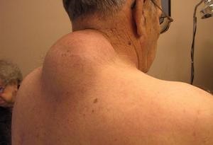Cauzele aparitiei tesutului adipos sub piele si modalitatile de tratare a acestuia