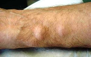 Cauzele aparitiei tesutului adipos sub piele si modalitatile de tratare a acestuia