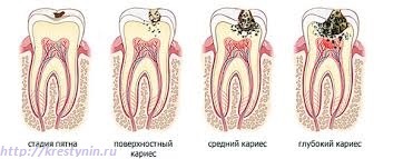 Профилактика на зъбния кариес, жизнена свят