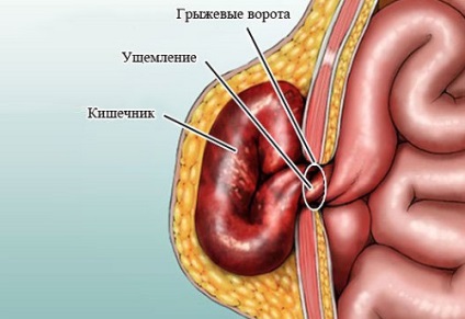 Hernia ombilicală la nou-născuți și tactici de tratament în caz de boală