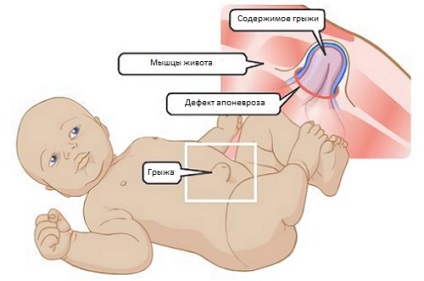 Hernia ombilicală la nou-născuți și tactici de tratament în caz de boală