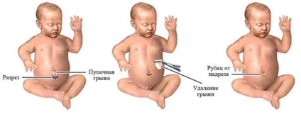 Hernia ombilicală în tratamentul nou-născuților, simptome, tencuieli