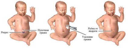 Пупкова грижа у новонароджених лікування, симптоми, пластирі