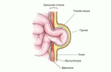 Hernia ombilicală în tratamentul nou-născuților, simptome, tencuieli