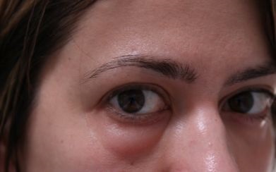Boli oculare obișnuite, centrul oftalmologic Artox